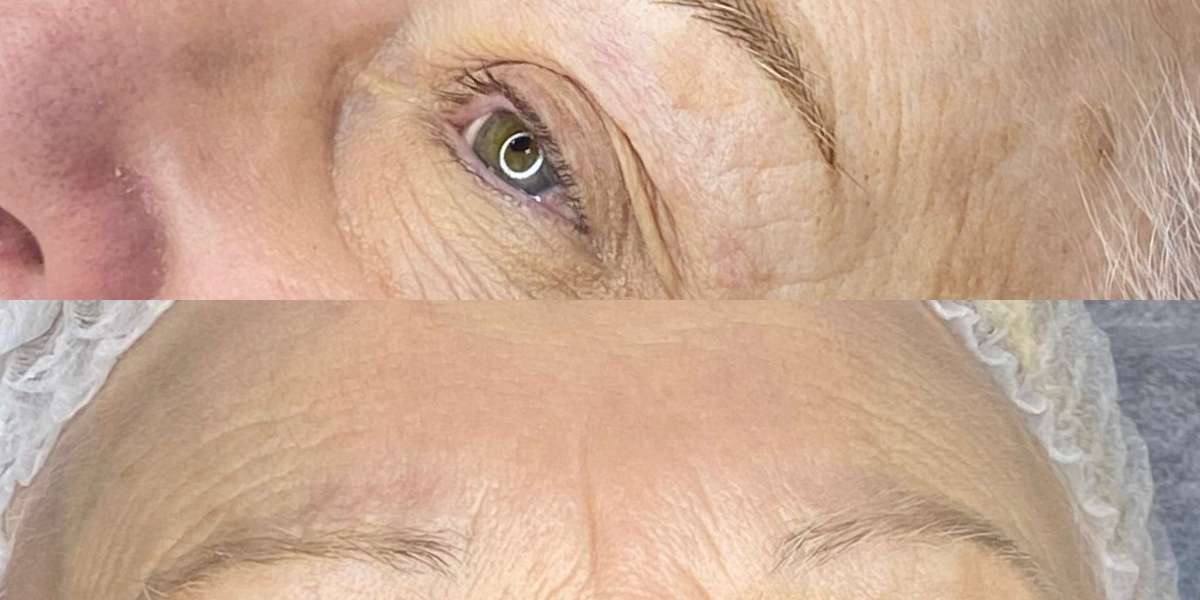 Understanding Laser Tattoo Removal and Why More People Are Considering It