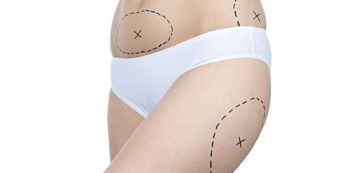 Liposuction for the Hips: Improving Body Contours